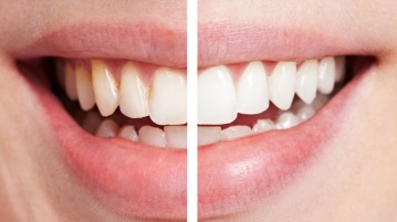 Zahnbleaching –  in 6 Schritten zum strahlenden Lächeln
