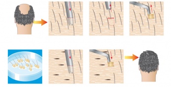 Ein Leben mit Haarimplantat